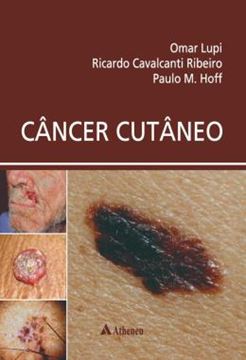 Imagem de CANCER CUTANEO