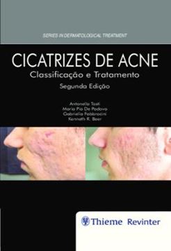 Imagem de CICATRIZES DE ACNE - CLASSIFICACAO E TRATAMENTO