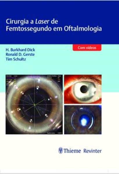 Picture of CIRURGIA A LASER DE FEMTOSSEGUNDO EM OFTALMOLOGIA