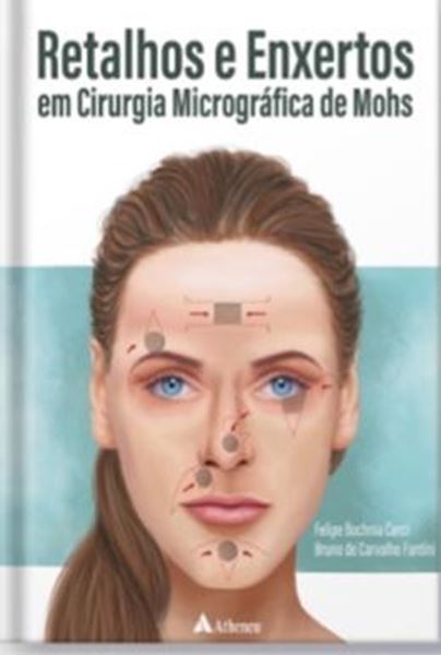 Picture of RETALHOS E ENXERTOS EM CIRURGIA MICROGRAFICA DE MOHS