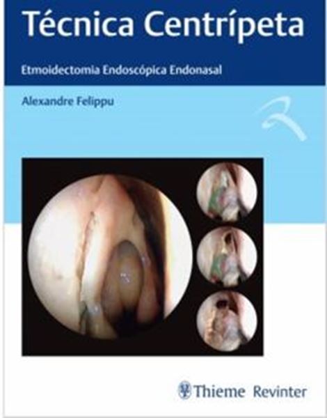 Picture of TECNICA CENTRIPETA - ETMOIDECTOMIA ENDOSCOPICA ENDONASAL
