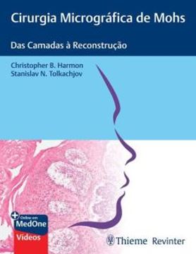 Imagem de CIRURGIA MICROGRAFICA DE MOHS